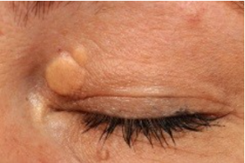 Xanthelasma