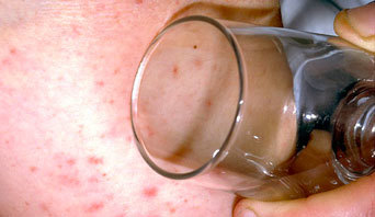 Photograph showing a red rash that doesn't disappear when pressed on by a glass