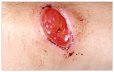 Hypergranulating wound