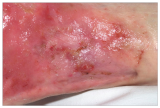 Erythema