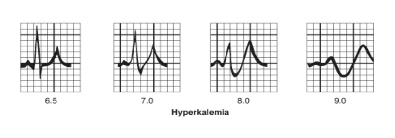 Hyperkalemia ECGs