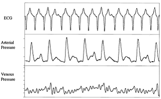 Image of rhythm strip