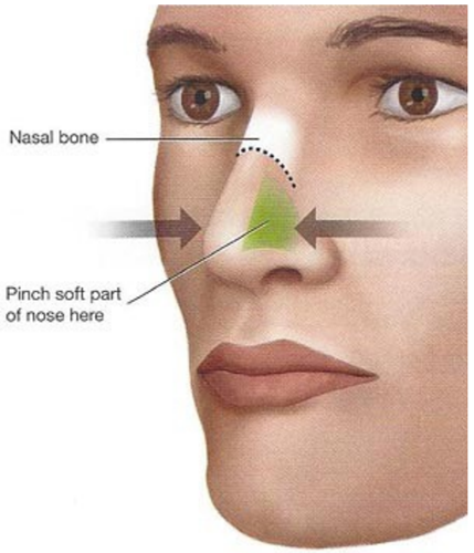 Image of a face showing where the nasal bone is and the correct place to pinch to stop a nose bleed