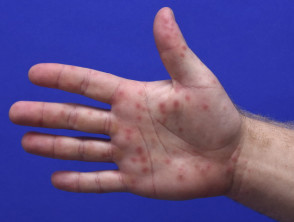 Cild with hand rash