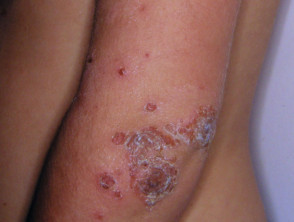 Child with Impetigo