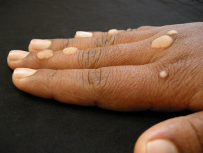 Child with finger warts