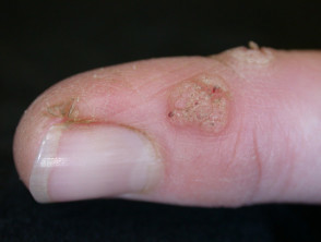 Child with finger warts