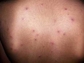 Child with Chickenpox