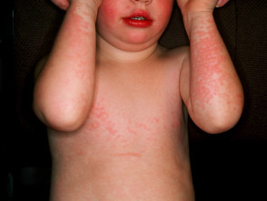 Child with Slapped cheek rash