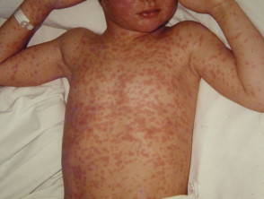 Child with Measles