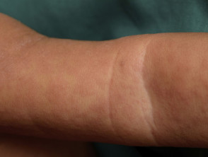 Child with Measles