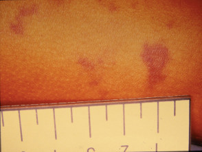 Child with Meningoccocal Disease