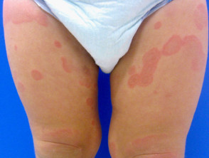 Child with Urticaria