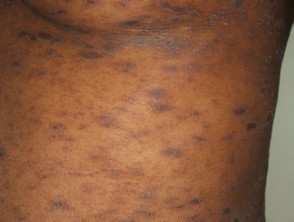 Child with Pityriasis Rosea