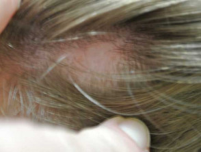 Child with Alopecia Areata