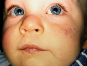 Child with Acne