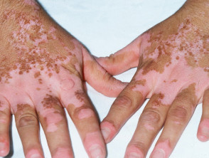 Child with Vitiligo