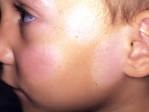 Child with Pityriasis Alba