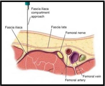 Fascia iliaca block diagram