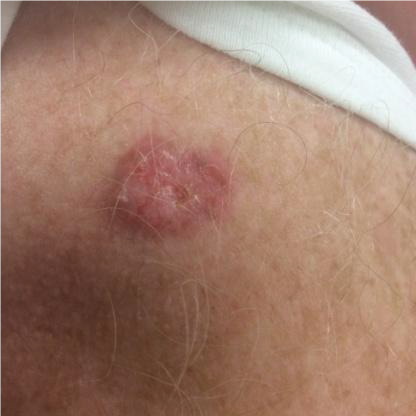 basal cell carcinoma