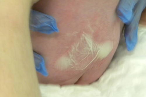 photo of neonate with EMLA cream on base of spine