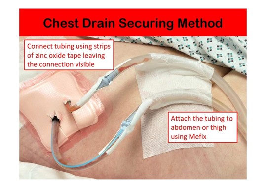 Chest drain securing method