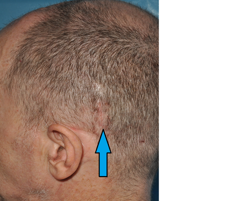 Photo of a man with a shaved head with an arrow pointing to a minor wound behind his left ear