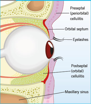 Orbital cellulitis diagram