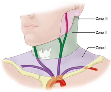 Diagram showing zones 1, 2 and 3 of the neck.
