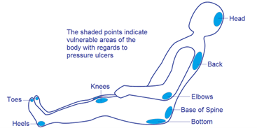 Prevent Pressure Ulcers 