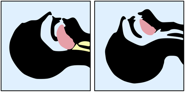 Tongue blocking airway diagram