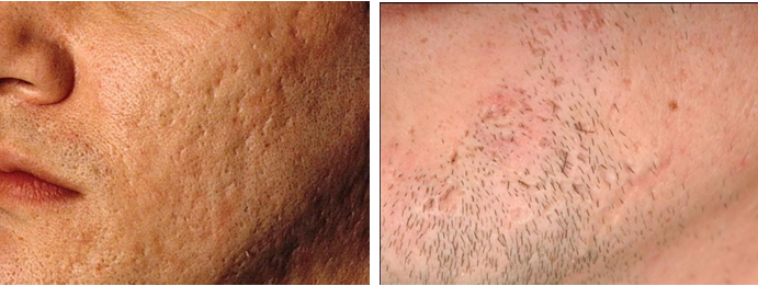 Two pictures of a face showing acne scarring