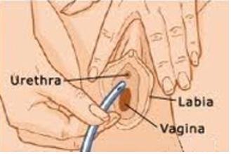 Diagram showing insertion of female urinary catheter