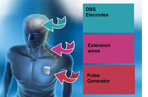 Image of the top half of a man with  an arrow pointing to his head which says DBS electrodes.  A second arrow points to his shoulder and says extension wires. The third wire points to his chest and says pulse generator.