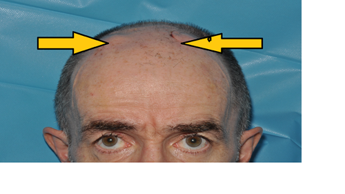 Picture of a man with a shaved head with two arrows pointing at a small wound on top of his head