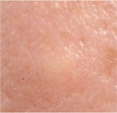 Epidermoid (sebaceous) cyst