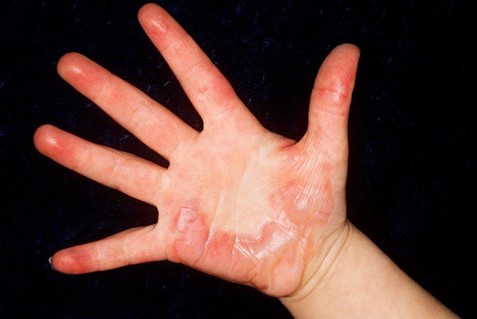 A hand with burnt skin