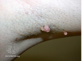 Skin Tags