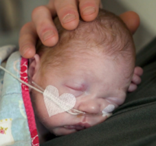 Photo of a newborn baby with a nasal tube with the adhesive tape cut into the shape of a heart