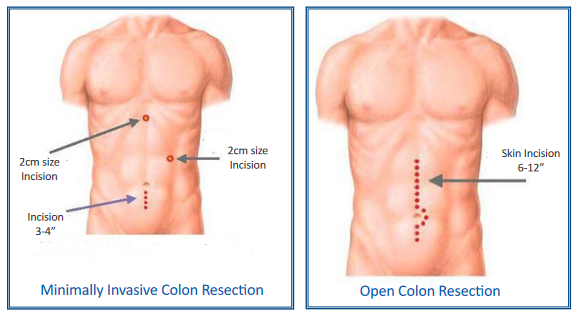 Laproscopic and open bowel surgey comparison