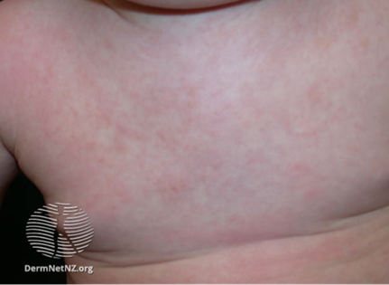 Roseola rash