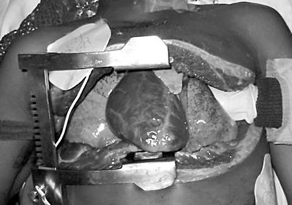 Clamshell thoracotomy with manual aortic compression