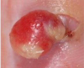 Pyogenic Granuloma