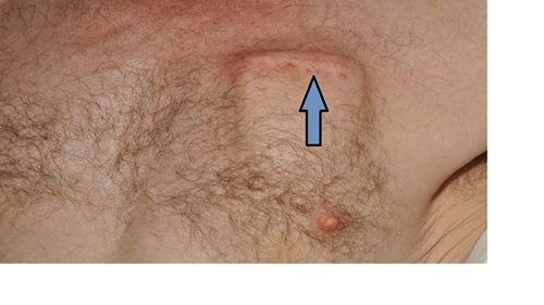 Photo of a man's chest with 4 suture marks in a sunken area above his left nipple.