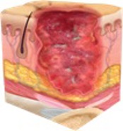 Full thickness skin loss